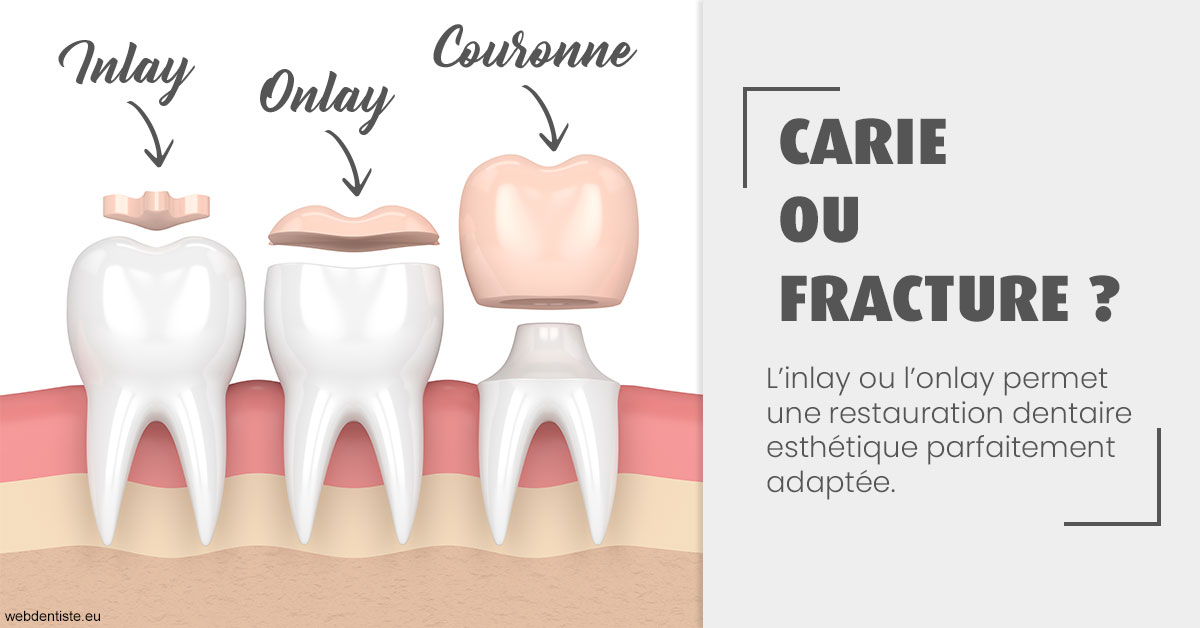 https://dr-roy-remy.chirurgiens-dentistes.fr/T2 2023 - Carie ou fracture 1
