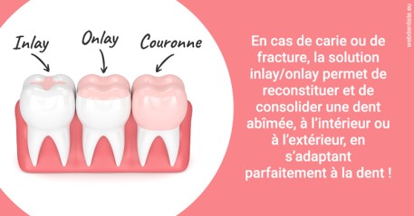 https://dr-roy-remy.chirurgiens-dentistes.fr/L'INLAY ou l'ONLAY 2