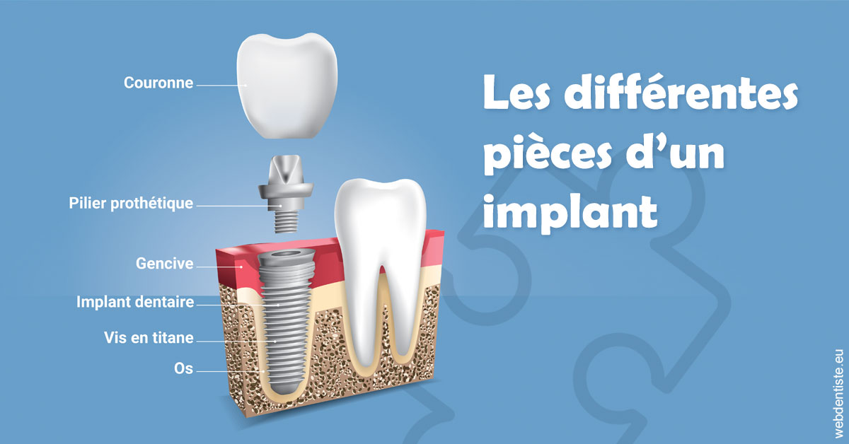 https://dr-roy-remy.chirurgiens-dentistes.fr/Les différentes pièces d’un implant 1